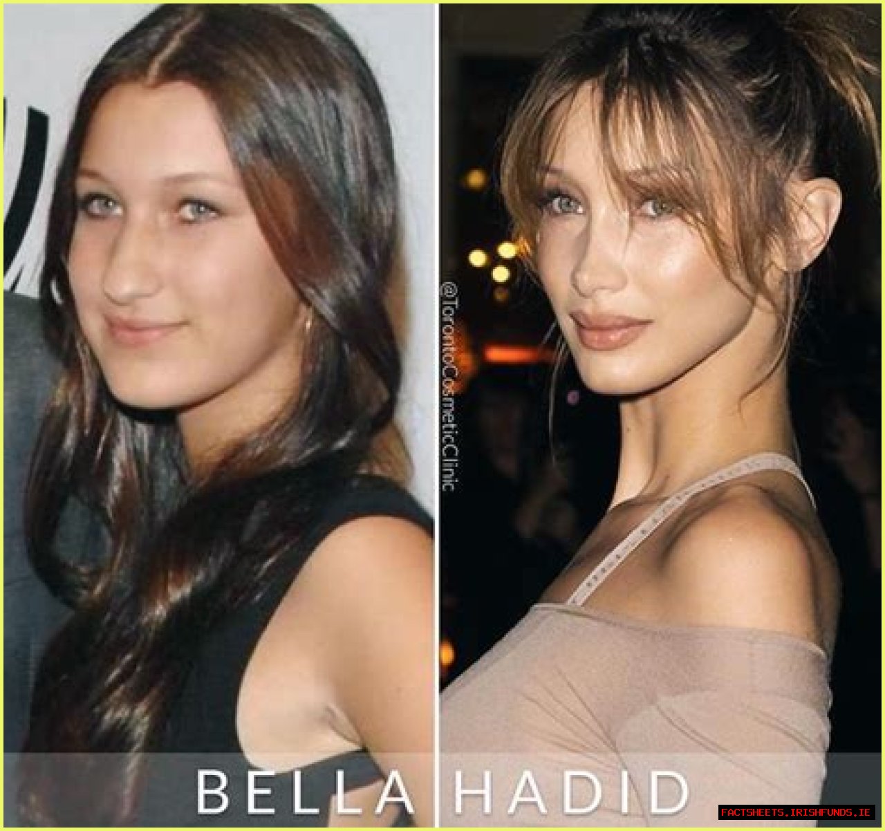 Bella Hadid: A Journey Through Transformation - Before And After